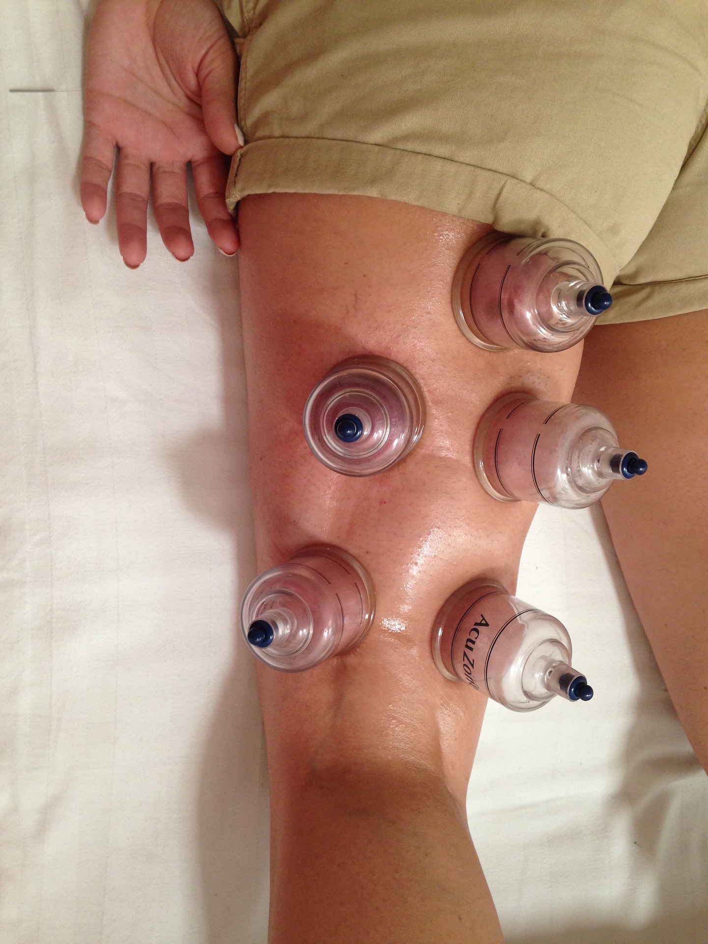 dry cupping